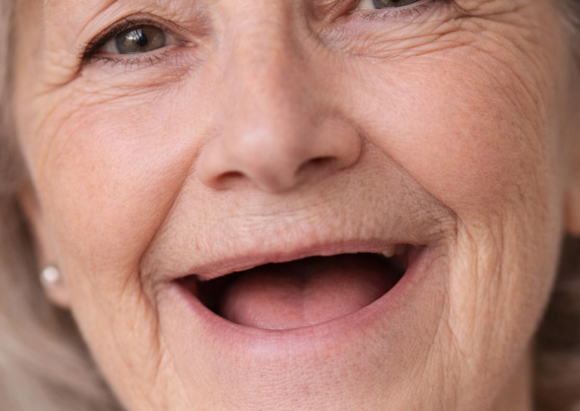 All-on-4 dental implants supporting a full arch of fixed teeth