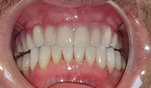 After All-on-4 treatment (fixed full-arch teeth)