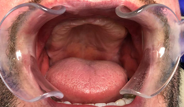 Before All-on-4 treatment (missing teeth / tooth loss)