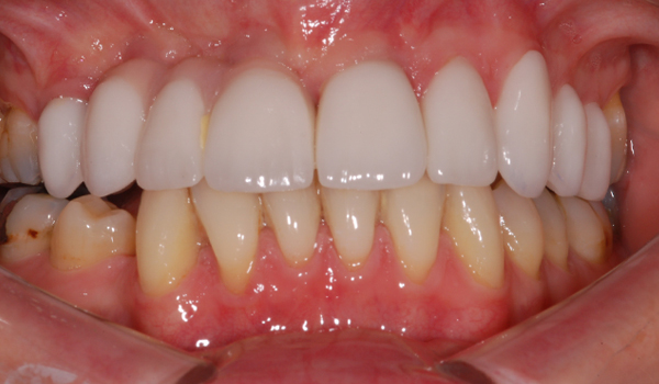 Before implant bridge treatment showing missing teeth