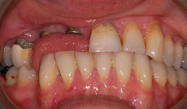 After implant bridge treatment replacing multiple missing teeth