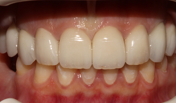 Case 03 after treatment
