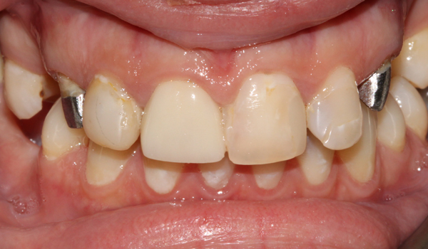 Case 03 before treatment