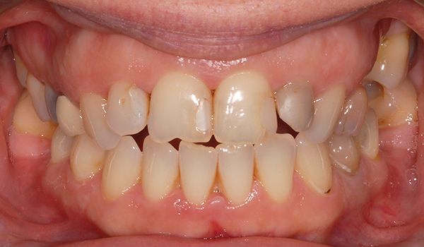 Case 04 before treatment