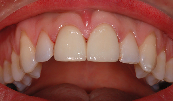 Before single tooth implant