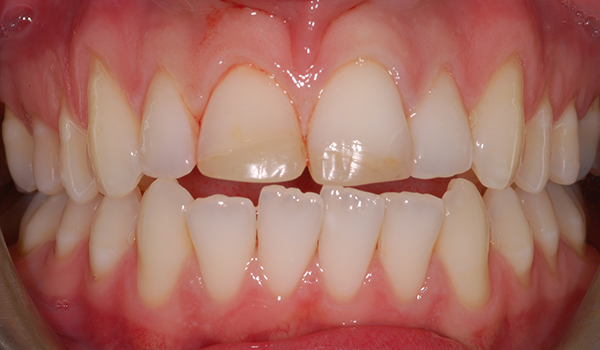 After single tooth implant