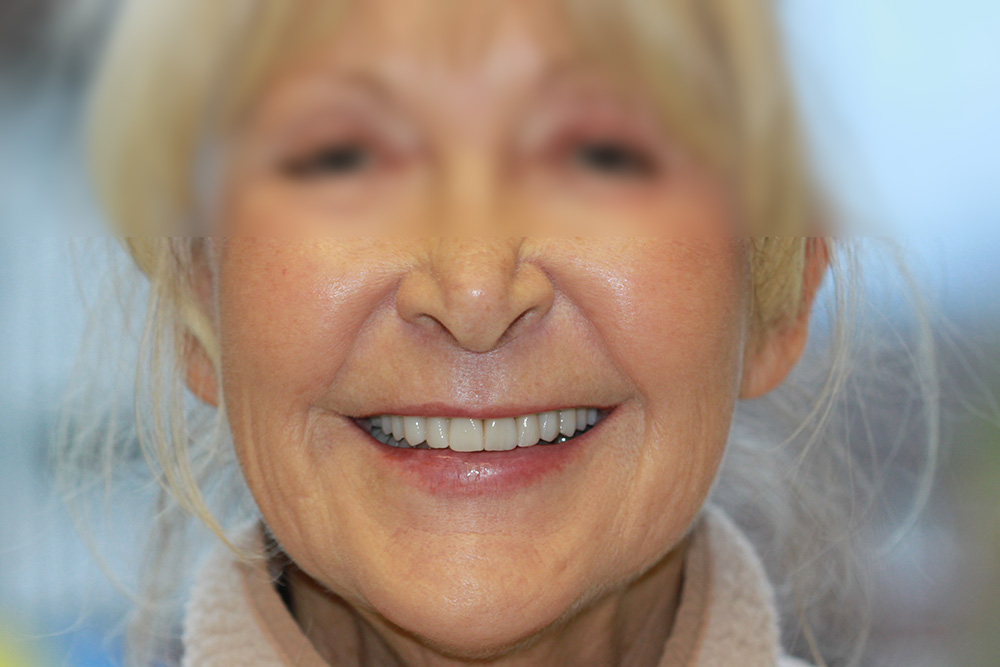 After complete smile transformation portrait