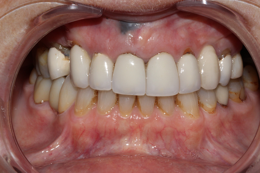 Before complete smile transformation close-up