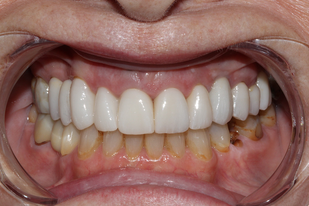 After complete smile transformation close-up