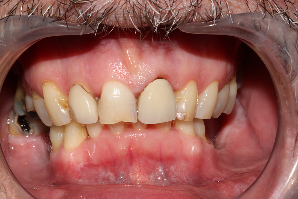 Before dental treatment showing worn and unsupported teeth