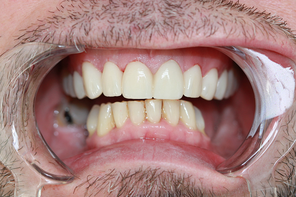 After dental treatment showing a natural-looking restored smile