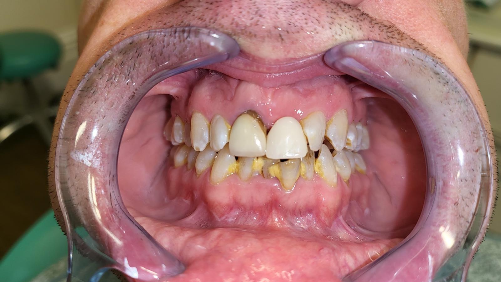 Before treatment showing misaligned anterior teeth