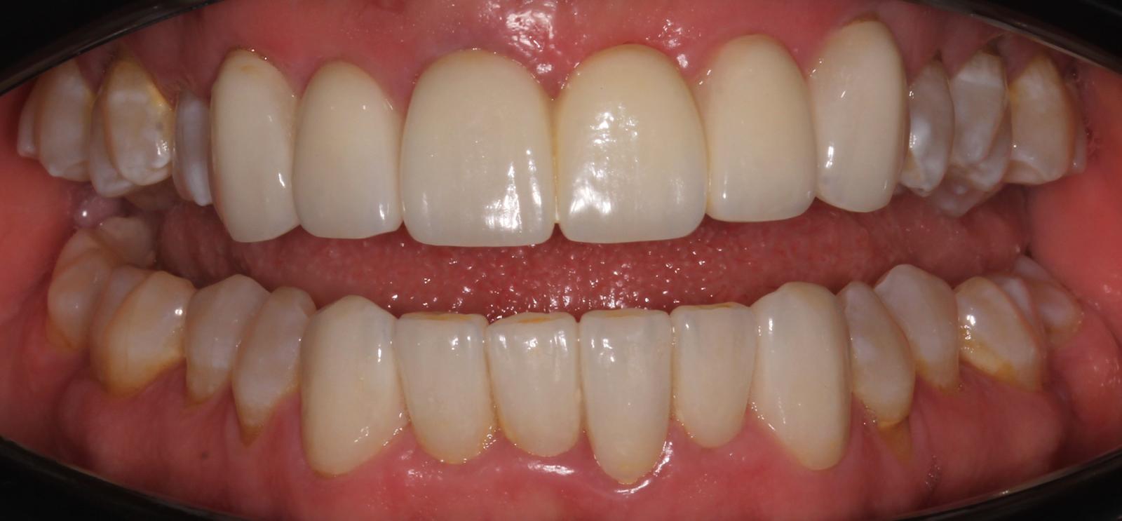 After layered zirconia crowns and bridge restoration