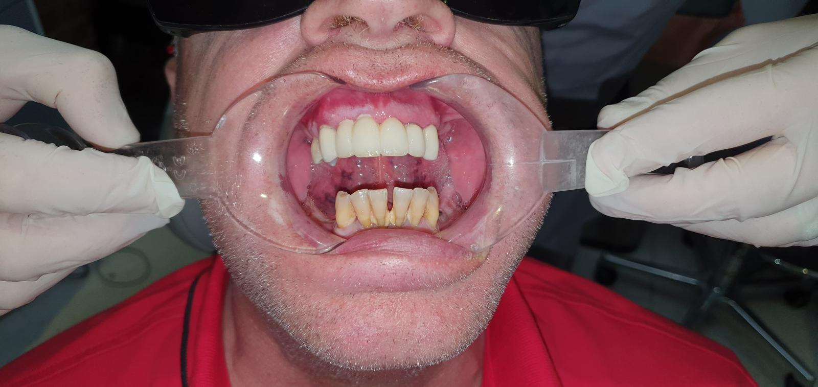 After lower arch All-on-4 implant restoration