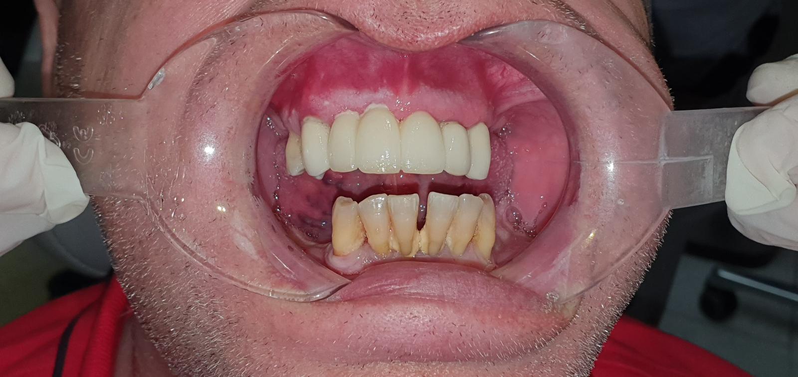Before treatment showing failing lower teeth