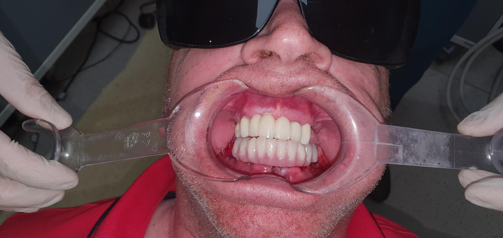After All-on-4 lower arch implant-supported prosthesis