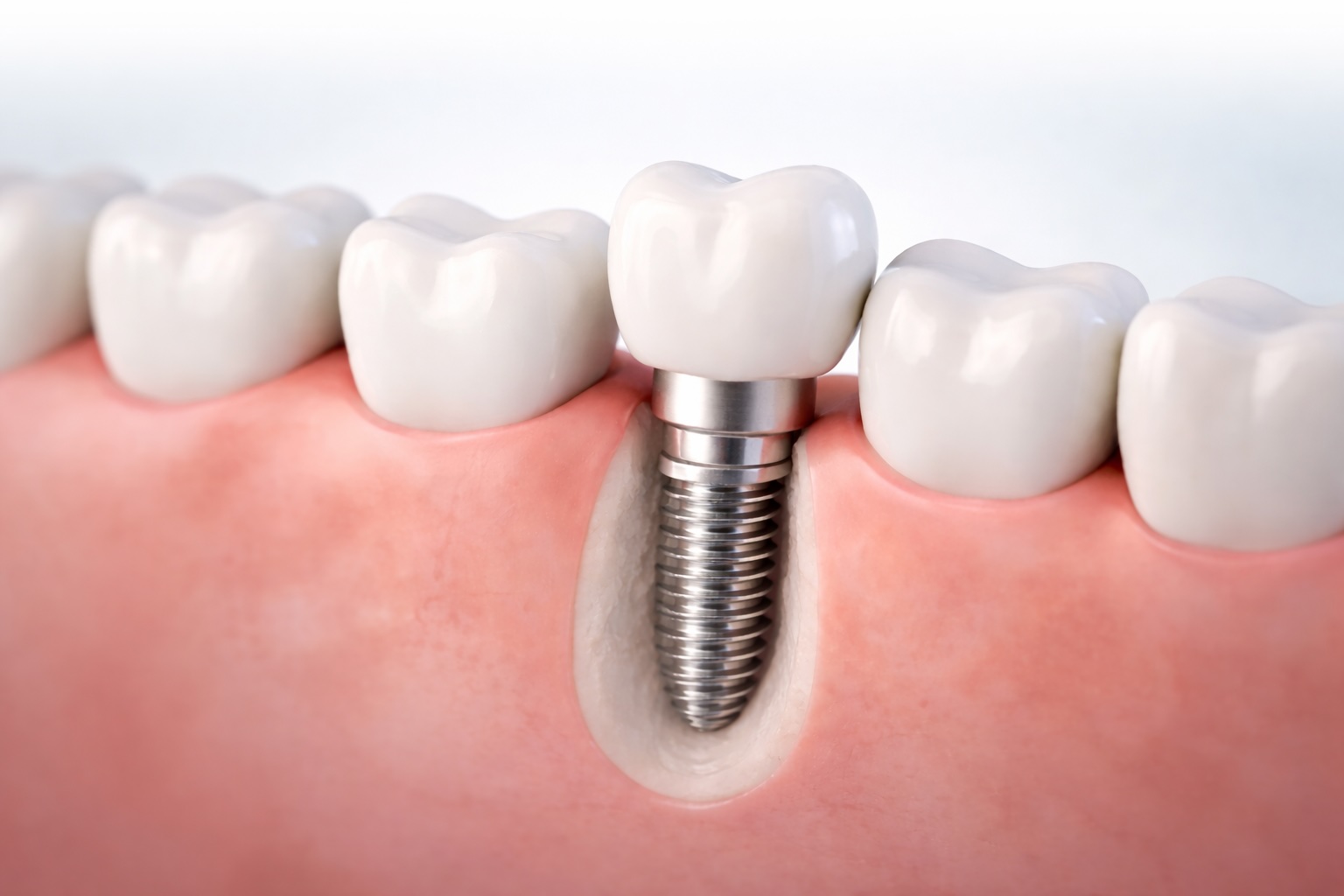 Single dental implant illustration