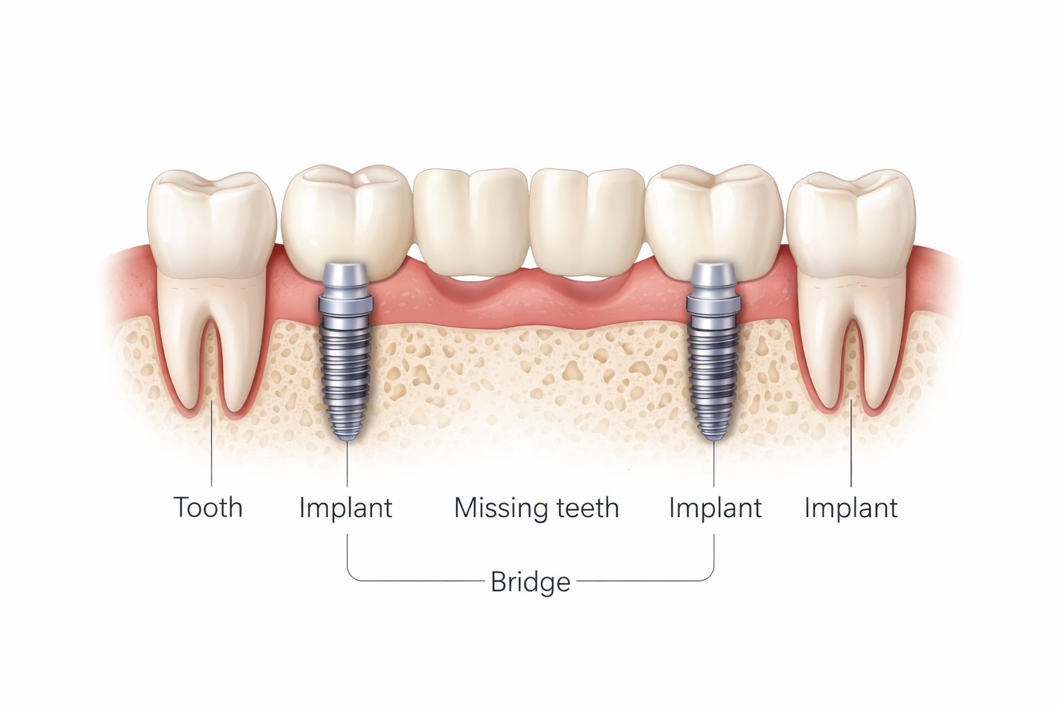 Implant bridge structure showing implants supporting a bridge