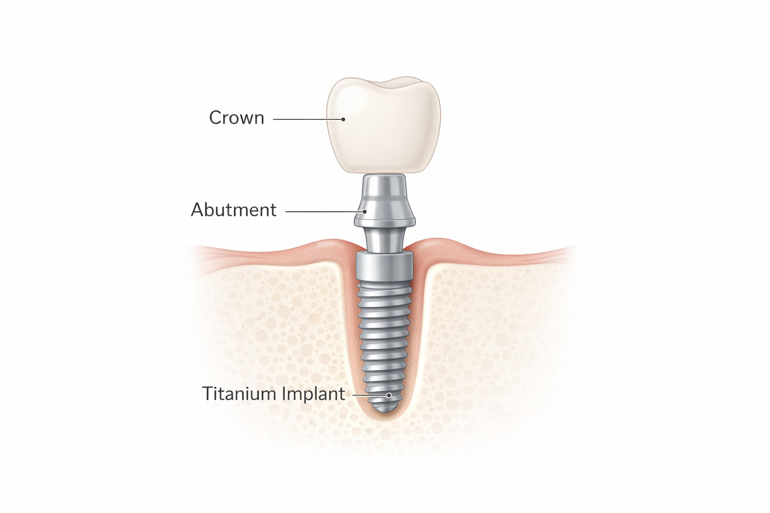 Dental implant structure