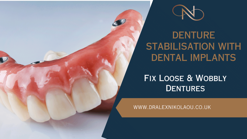 Denture Stabilisation With Dental Implants: Fix Loose and Wobbly Dentures