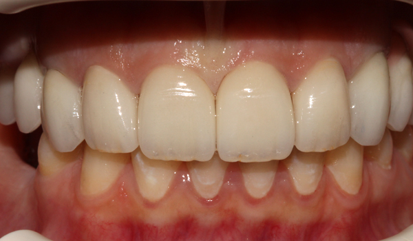 dental implants hale greater manchester